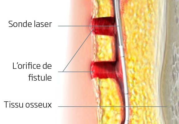 Percer un kyste pilonidal avec une aiguille : méthodes et précautions