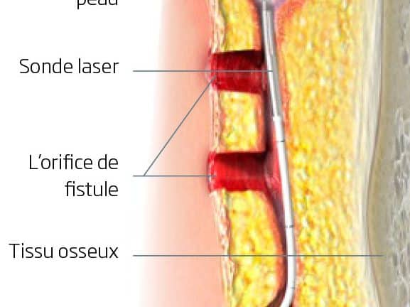 découvrez tout ce qu'il faut savoir sur le kyste pilonidal : de la procédure de perçage aux précautions à prendre pour une guérison efficace. informez-vous sur les symptômes, les traitements et les conseils pour éviter les récidives.