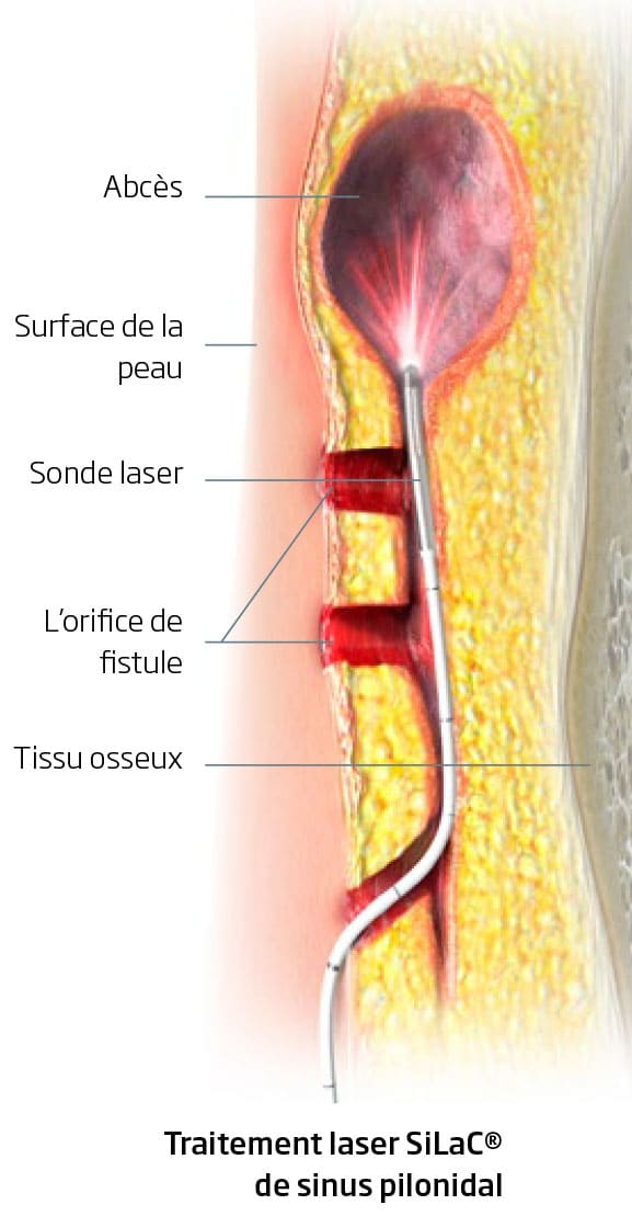 Percer un kyste pilonidal avec une aiguille : méthodes et précautions